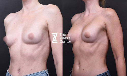Ballerina Boobs, Explained: What 150cc of Motiva Implants Really Looks Like