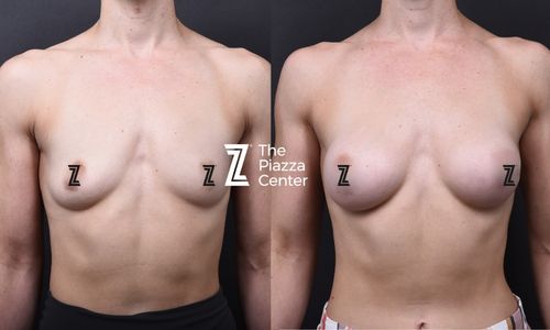 Post-Pregnancy Breast Augmentation: How 205cc of Motiva Restored Natural Volume