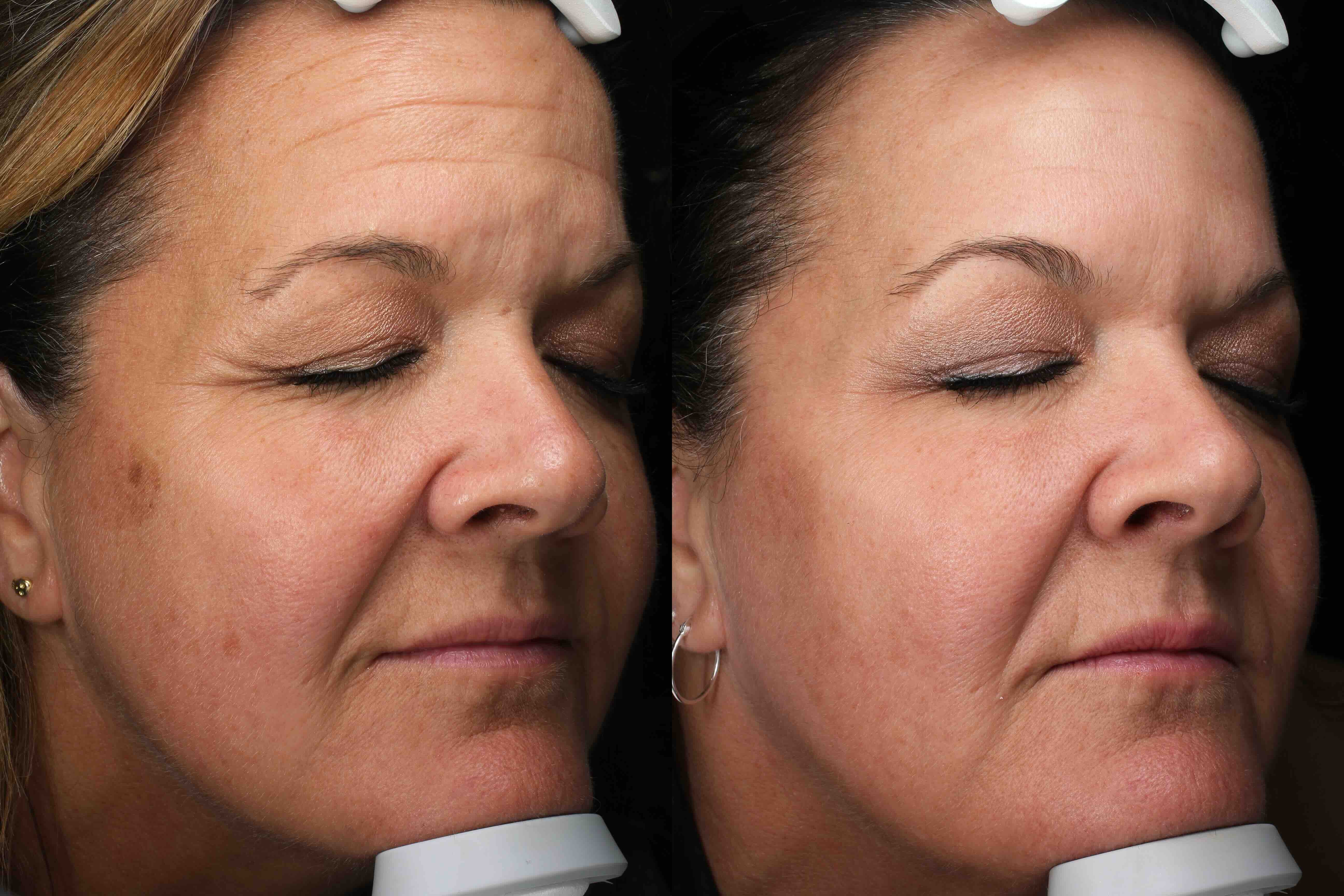 BBL HERO + MOXI and Botox: A 54-Year-Old's Pigmentation Result
