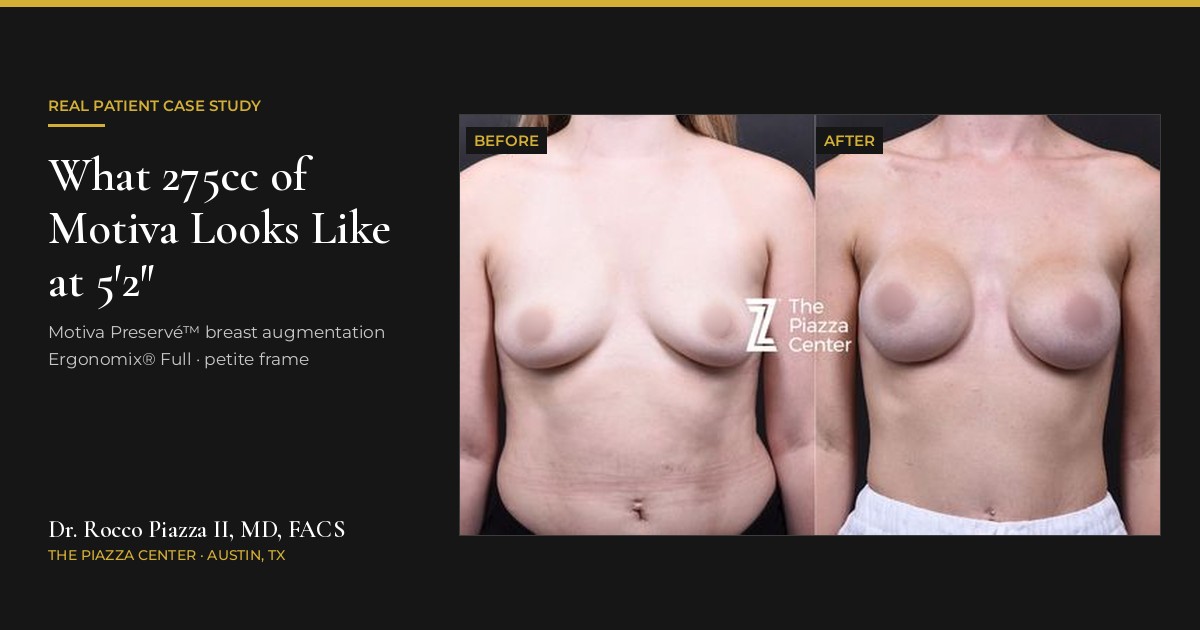 Breast Implants for Petite Women: What 275cc of Motiva Looks Like at 5'2"