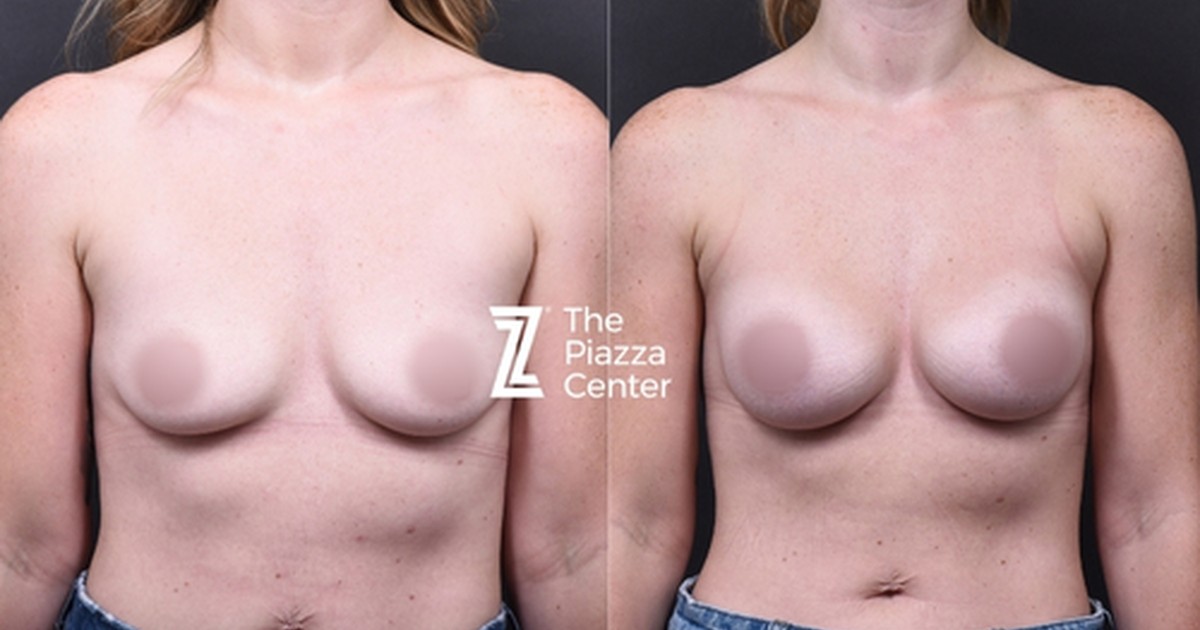 Do I Need a Breast Lift? How 230cc of Motiva Restored Fullness Without One