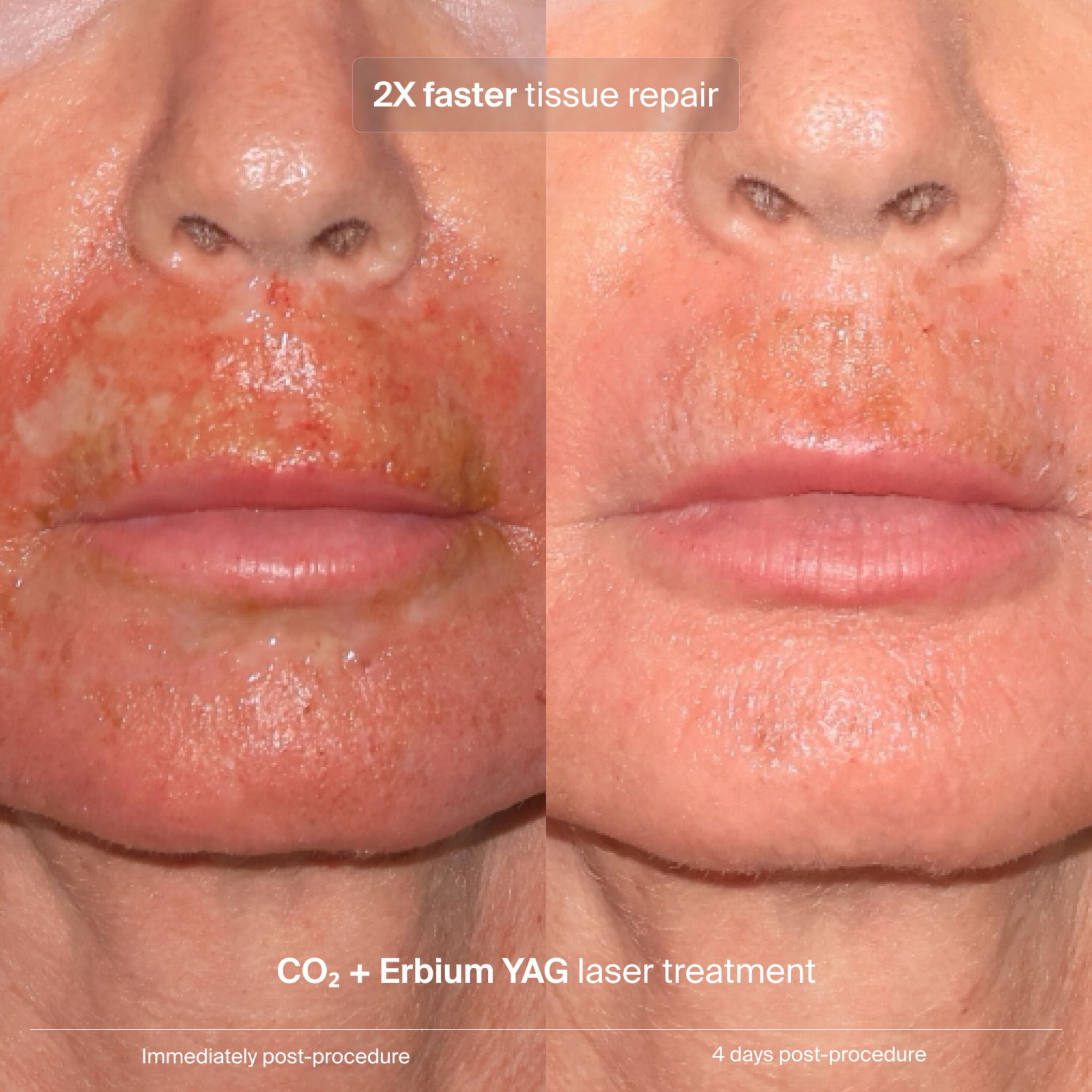 Erbium YAG laser recovery: immediately post-procedure compared with four days post-procedure, showing 2X faster tissue repair
