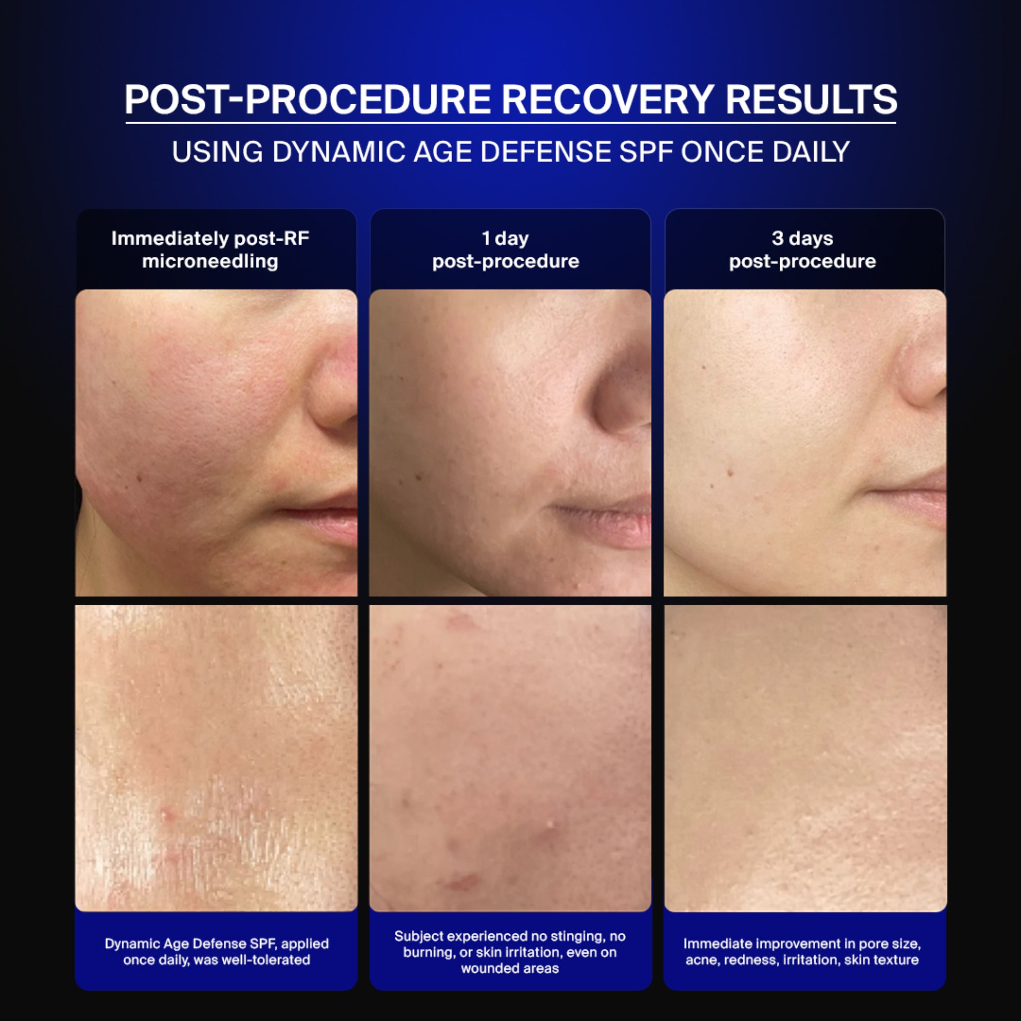 Post-procedure recovery results using Dynamic Age Defense SPF once daily: immediately post-RF microneedling, one day and three days post-procedure