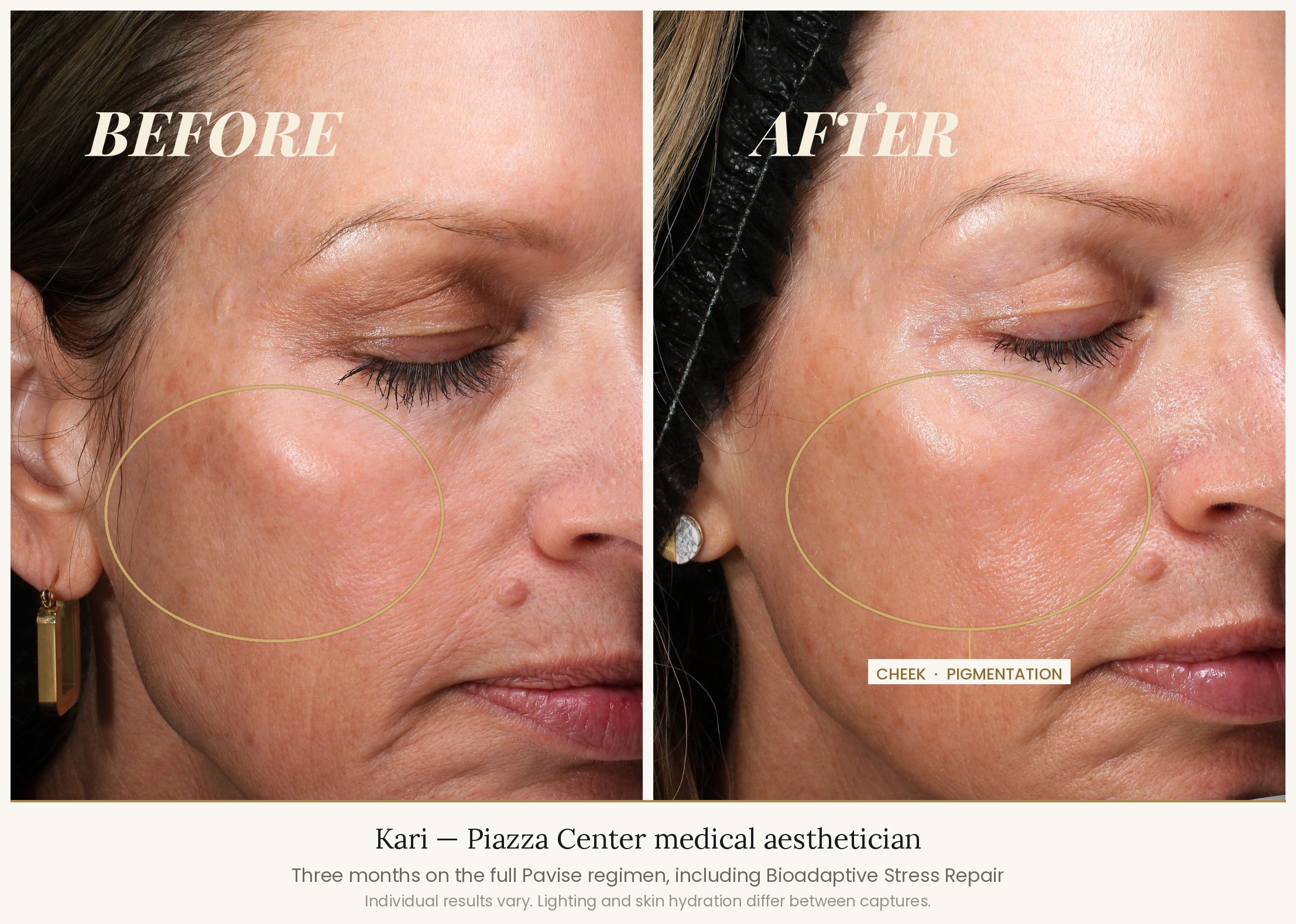 Kari, lead medical aesthetician at The Piazza Center in Austin, VISIA standardised before and after images three months apart on the full Pavise regimen, cheek pigmentation field marked on both frames.