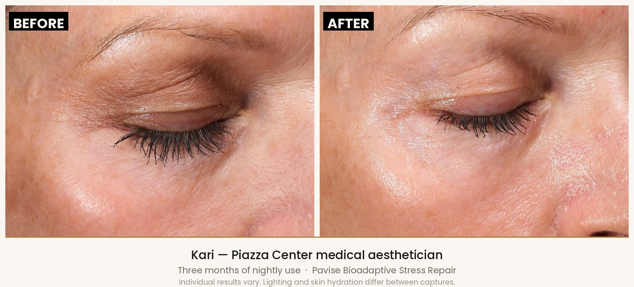 Kari's periorbital area in VISIA standardised images three months apart on the full Pavise regimen including Precision Eye Lift, with the upper eyelid and under-eye regions marked.