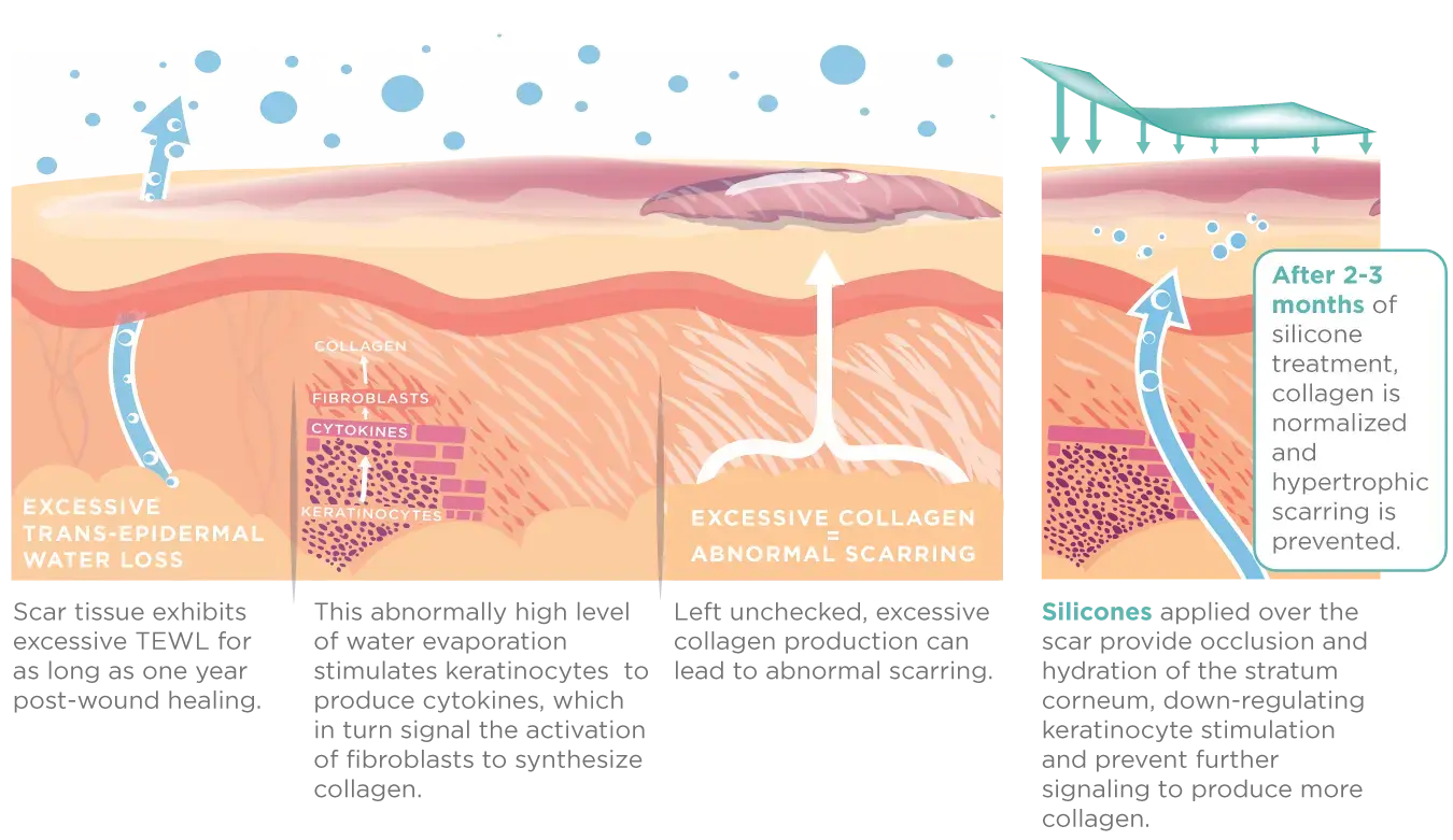 Diagram showing how silicone scar gel works: it reduces moisture loss from a healing scar and calms the excess collagen that causes raised scarring