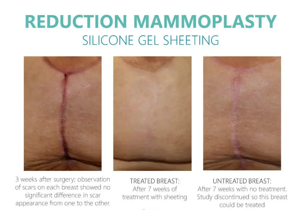 Silicone scar sheeting before and after on a breast reduction scar, treated side versus untreated side at 7 weeks