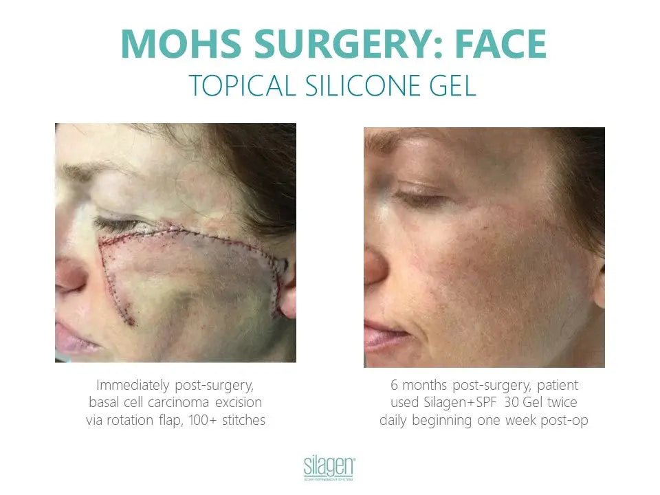 Facial surgical scar before and after 6 months of Silagen silicone scar gel with SPF 30, applied twice daily from one week after surgery