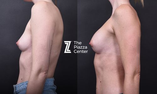 Before and after side profile showing natural slope after Motiva Ergonomix breast augmentation, Austin, TX