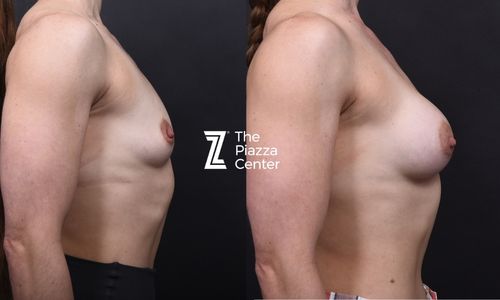Lateral view before and after natural breast augmentation restoring post-pregnancy volume with Motiva implants, Austin TX