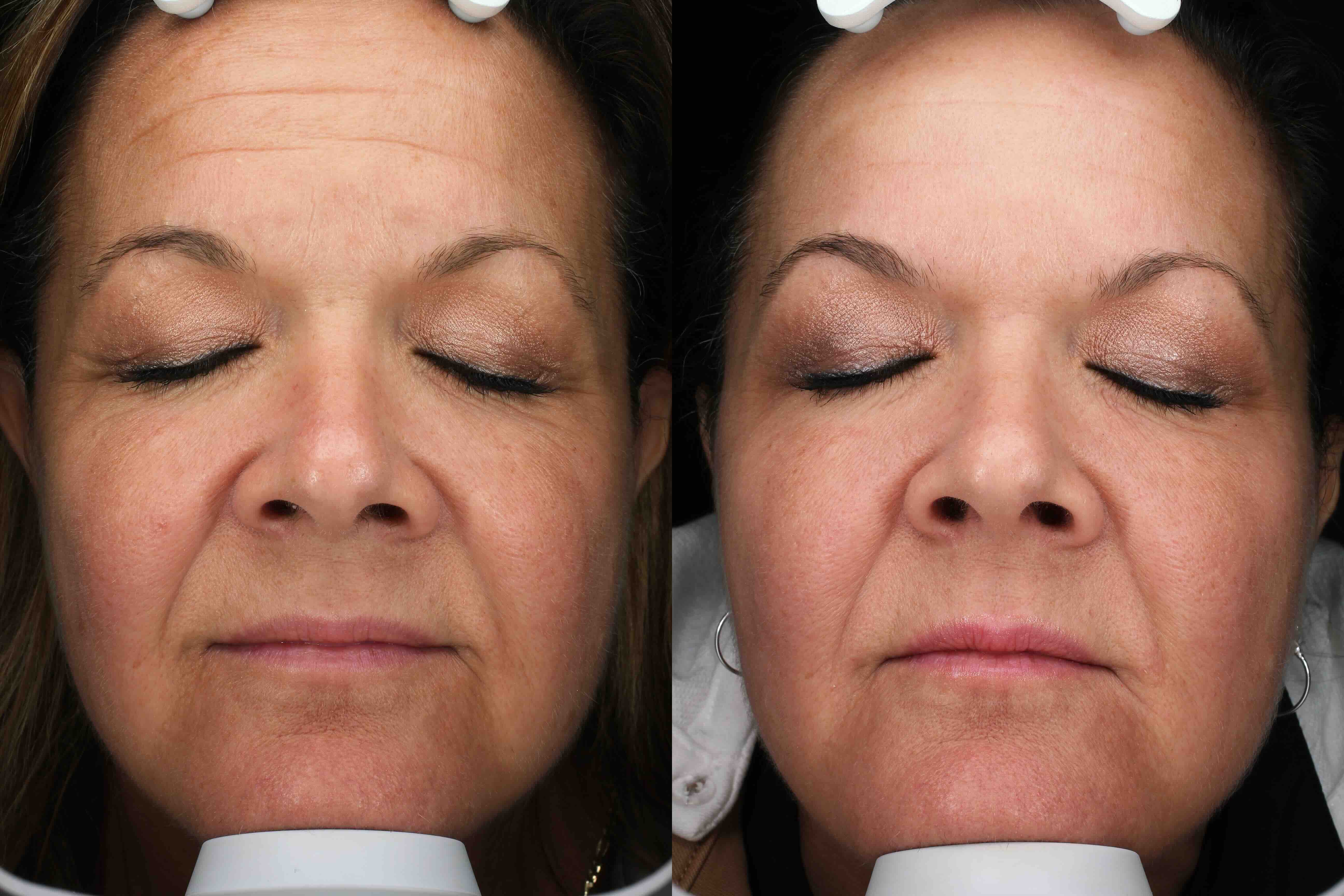 Front view before and after BBL HERO, Moxi laser and Botox in Austin: more even skin tone and softened forehead lines, woman age 54