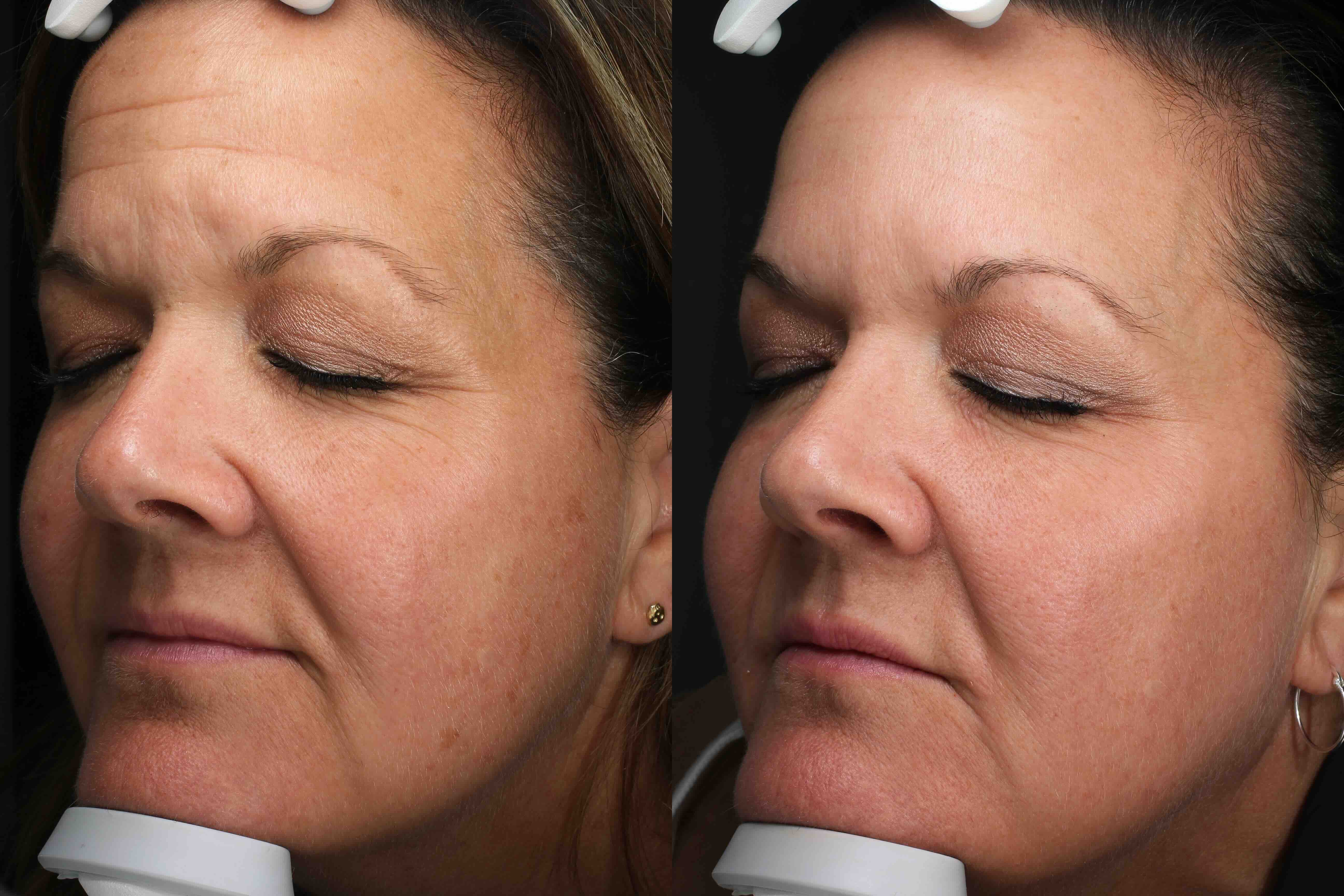 Right oblique before and after Moxi and BBL HERO laser in Austin: reduced freckling and smoother skin texture across the cheek, woman age 54