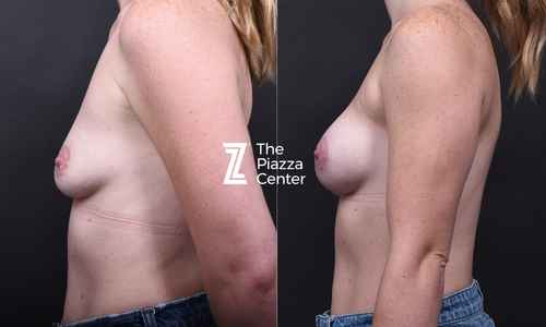 Left side profile before and after natural breast implants restoring post-breastfeeding volume without a lift, Austin, Texas