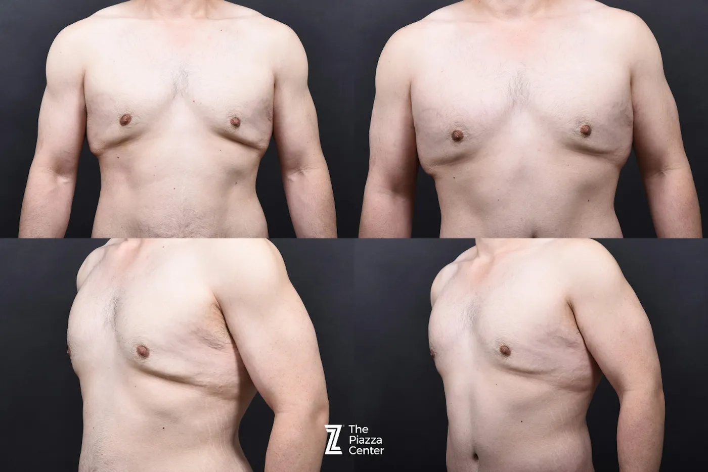 Austin Liposuction Before & After Gallery - Patient 313599 - Image 9 - The Piazza Center