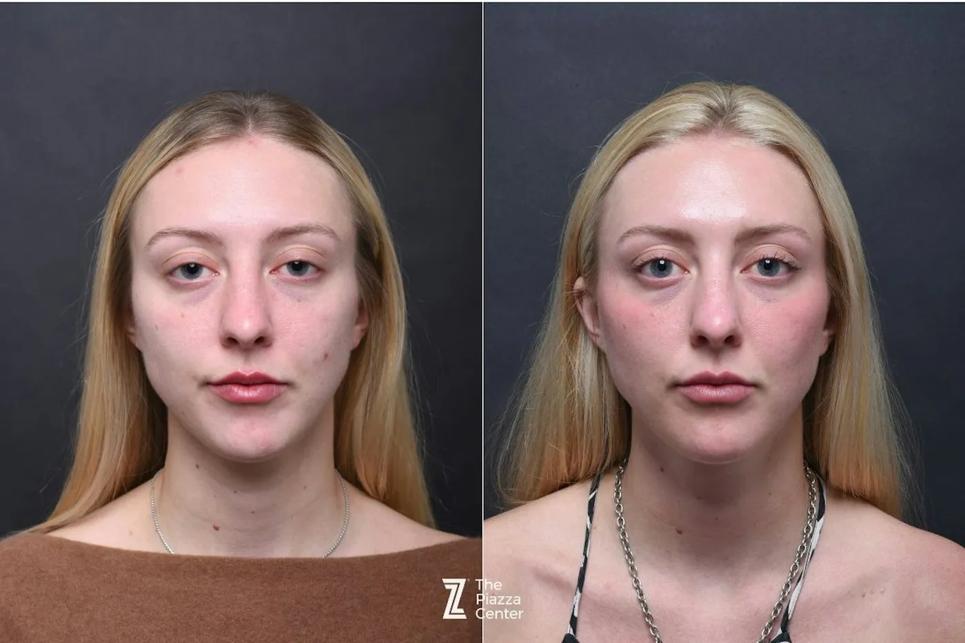 Austin Injectable Fillers Before & After Gallery - Patient 383581 - Image 1 - The Piazza Center