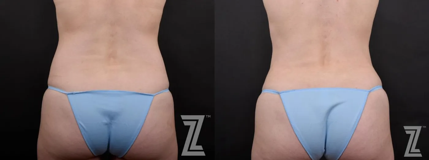 Austin Posterior View from Mommy Makeover with Surgical Plan for a Breast Augmentation and a Contoured Waistline With an Abdominoplasty in Austin, TX by Dr. Rocco Piazza - Before & After - The Piazza Center