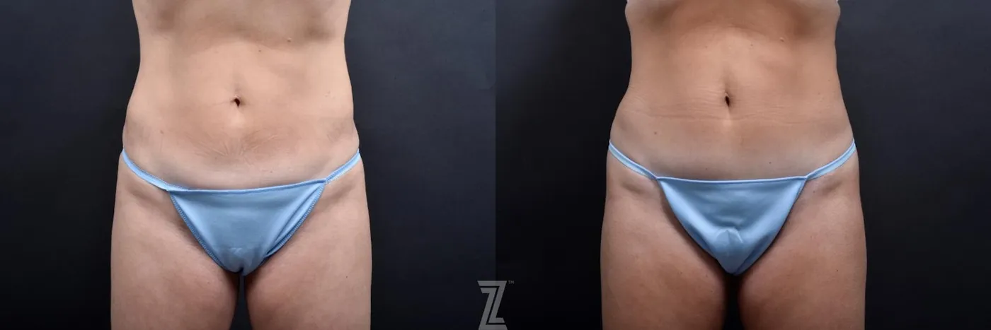 Austin Skin Pinch Before & After Gallery - Patient 132886939 - Image 1 - The Piazza Center