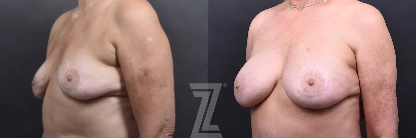 Austin Fat Transfer Breast Augmentation Before & After Gallery - Patient 311307 - Image 2 - The Piazza Center