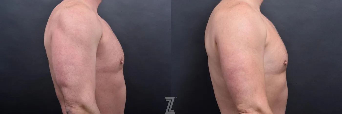 Austin Liposuction Before & After Gallery - Patient 132886943 - Image 7 - The Piazza Center