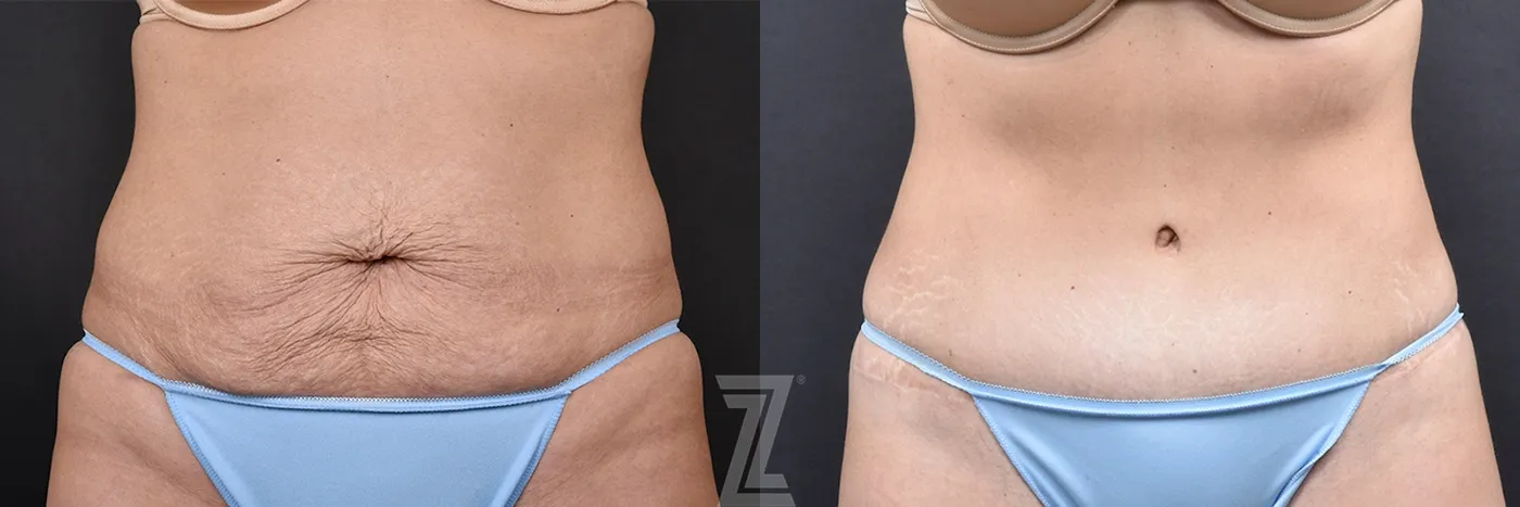 Austin Front View of 39-Year-Old Female Patient Mommy Makeover Before & Afters in Austin, TX - The Piazza Center - Dr. Rocco Piazza - The Piazza Center