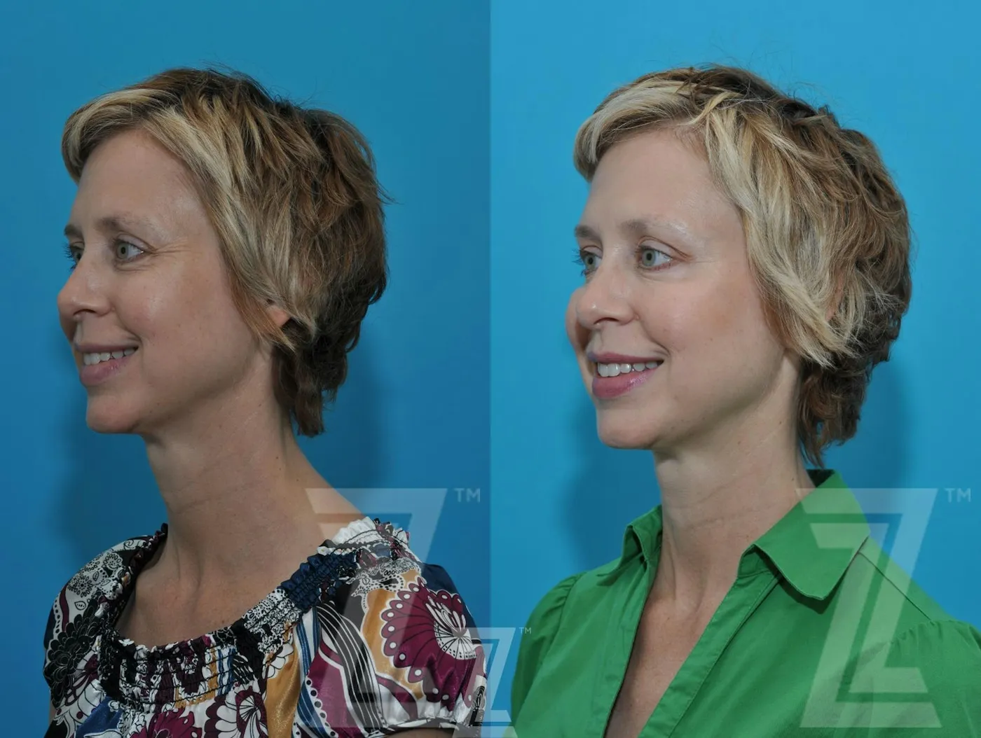 Austin Wrinkle Relaxers Before & After Gallery - Patient 132906319 - Image 4 - The Piazza Center