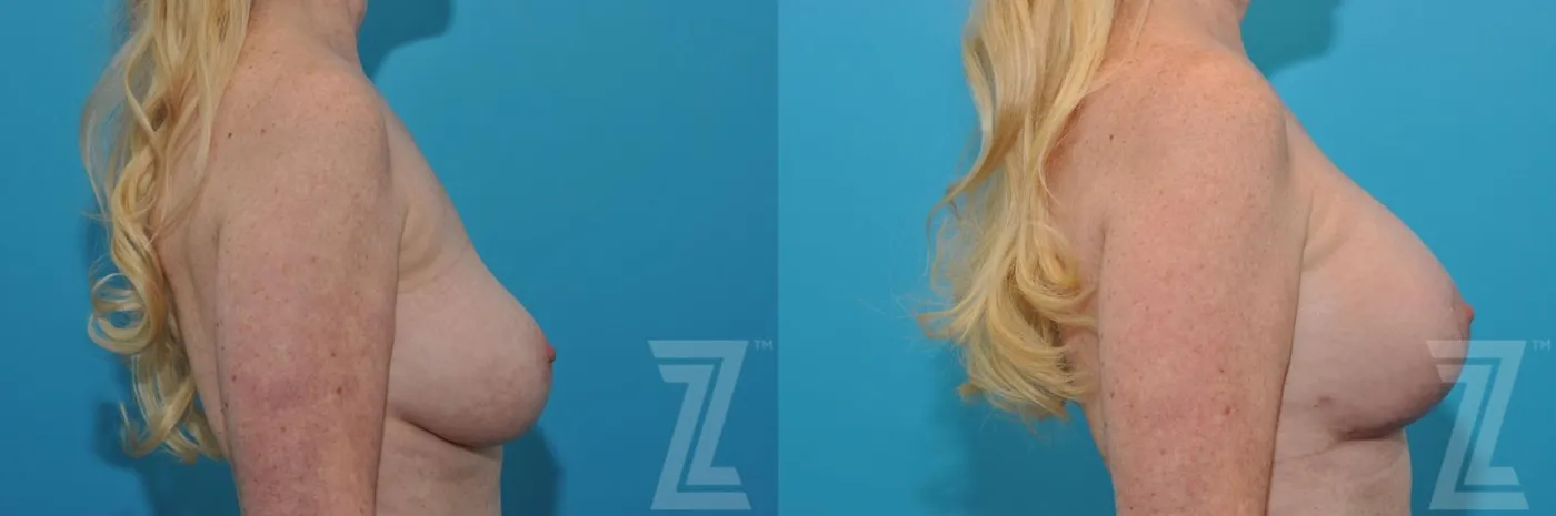 Austin Breast Augmentation Revision Before & After Gallery - Patient 132794909 - Image 5 - The Piazza Center