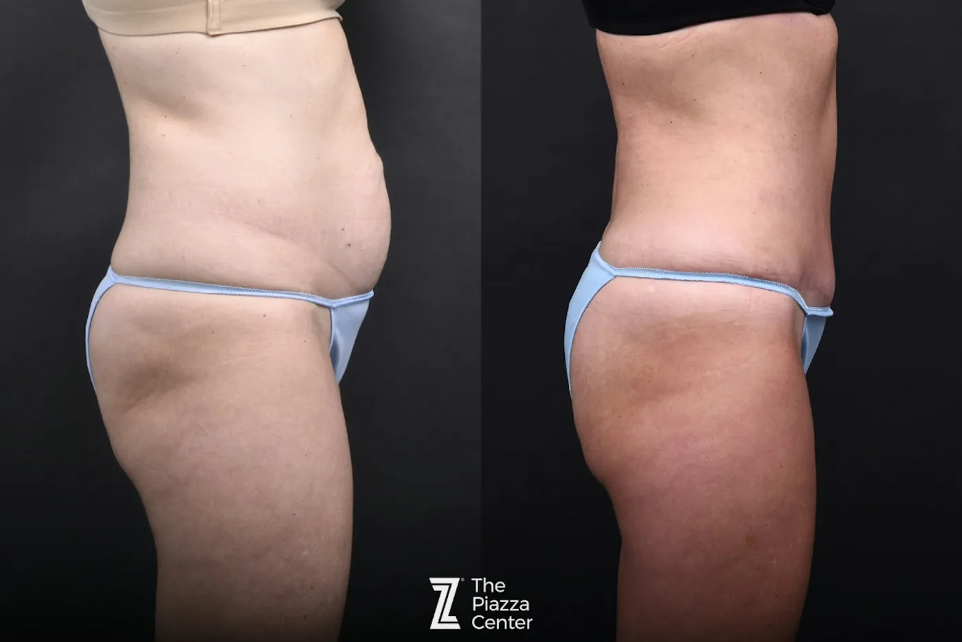 Austin Liposuction Before & After Gallery - Patient 260024 - Image 2 - The Piazza Center