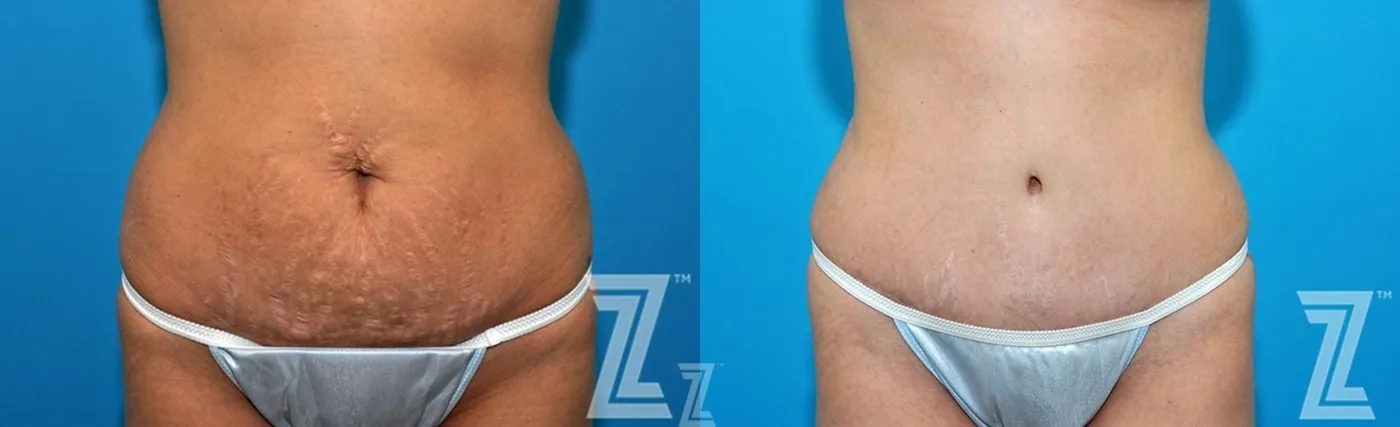 Austin 36 year old woman 1 year post op front abdominal view mommy makeover - Austin Tx, The Piazza Center - The Piazza Center