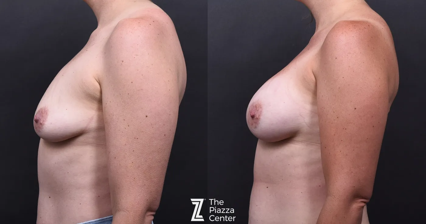 Austin Motiva Implants Before & After Gallery - Patient 261782 - Image 5 - The Piazza Center