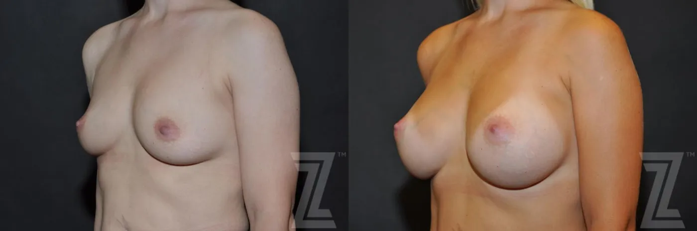 Austin Oblique View 6 Months After Breast Augmentation in Austin, TX Before & After by Dr. Rocco Piazza - The Piazza Center