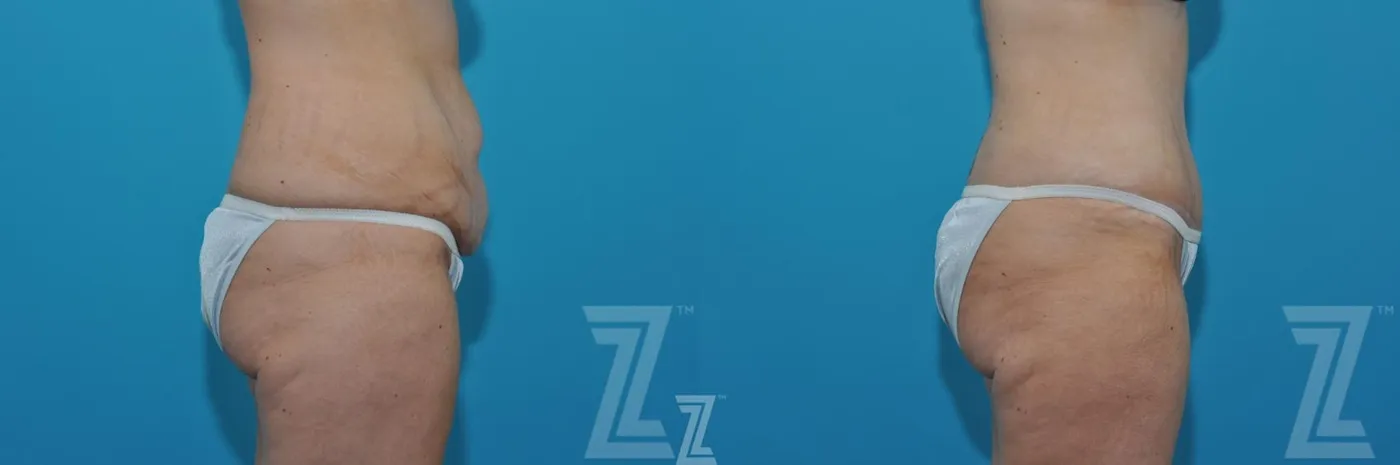 Austin Liposuction Before & After Gallery - Patient 132903278 - Image 4 - The Piazza Center