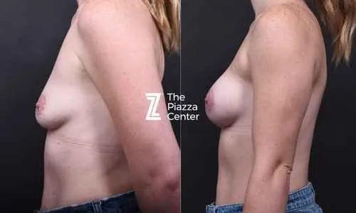 Left side profile before and after natural breast implants restoring post-breastfeeding volume without a lift, Austin, Texas
