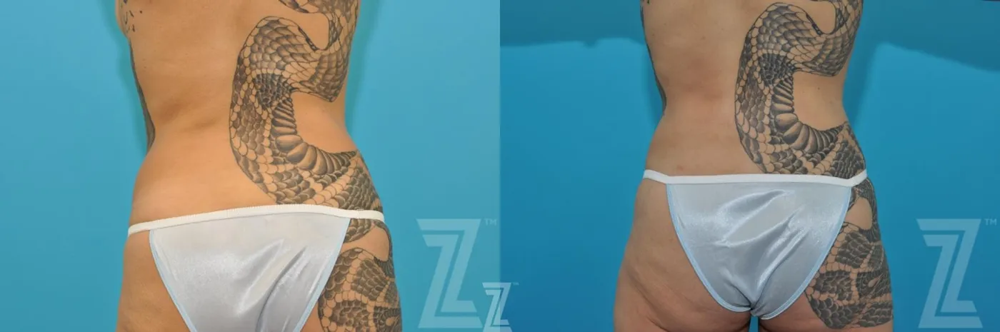 Austin Liposuction Before & After Gallery - Patient 132887302 - Image 6 - The Piazza Center