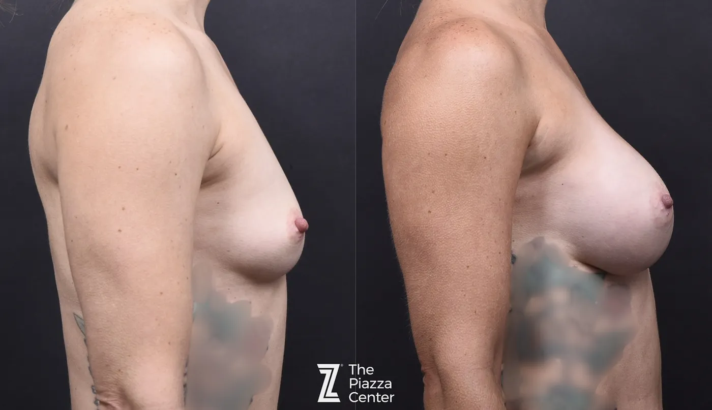 Austin Breast Augmentation Before & After Gallery - Patient 141191 - Image 3 - The Piazza Center