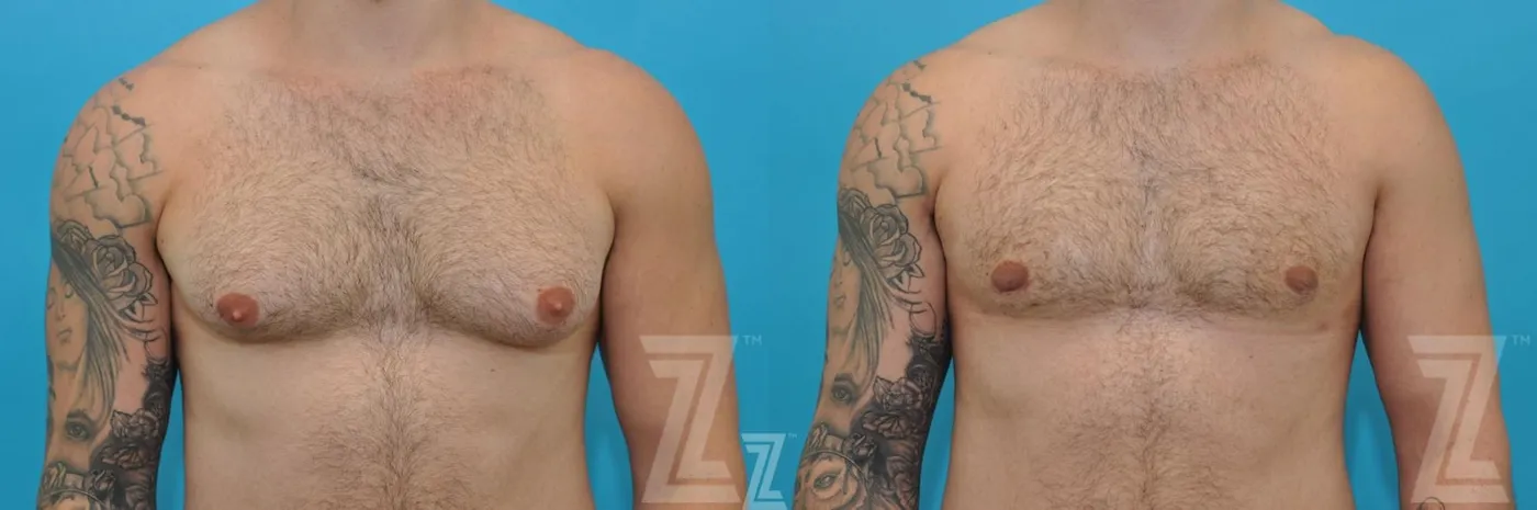 Austin Male Breast Reduction Before & After Gallery - Patient 132963603 - Image 1 - The Piazza Center