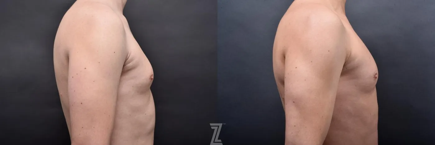 Austin Liposuction Before & After Gallery - Patient 132886947 - Image 8 - The Piazza Center