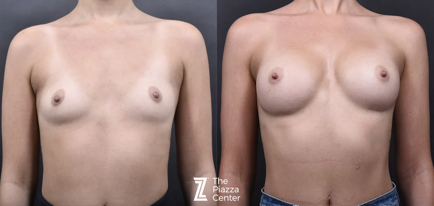 Austin Breast Augmentation Before & After Gallery - Patient 790705 - Image 1 - The Piazza Center