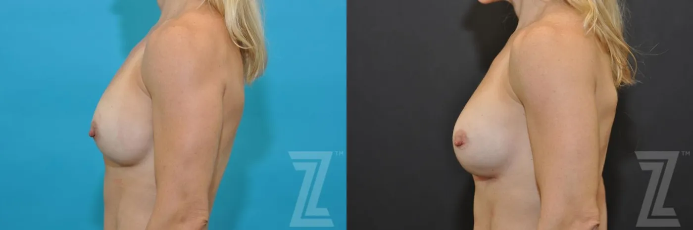 Austin Breast Augmentation Revision Before & After Gallery - Patient 132886580 - Image 3 - The Piazza Center