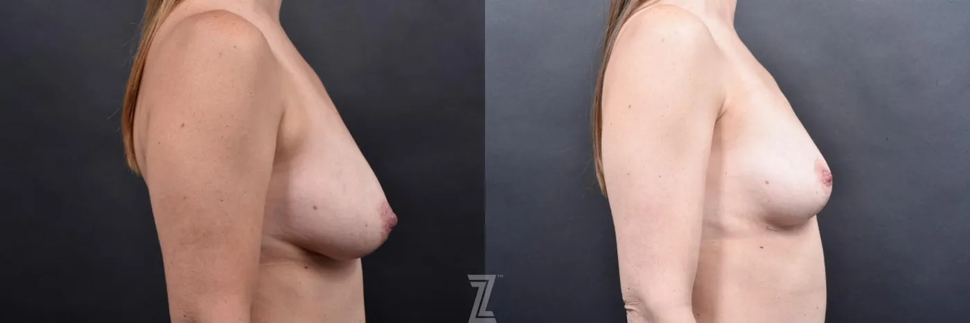 Austin Breast Reduction Before & After Gallery - Patient 606521 - Image 5 - The Piazza Center