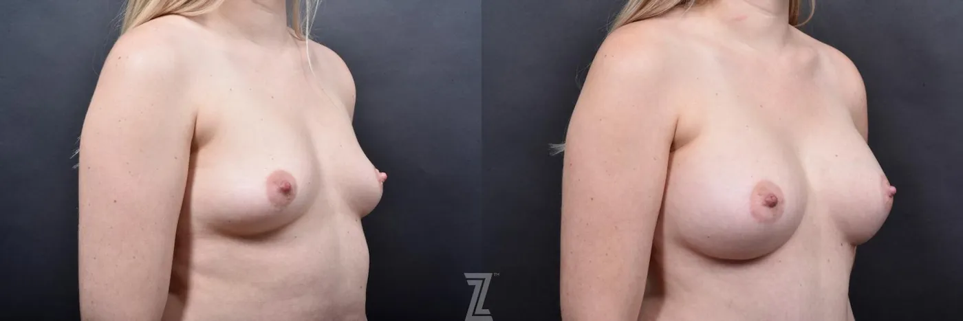 Austin Oblique View of Breast of 29-Year-Old Mommy Makeover Before & After by Dr. Rocco Piazza in Austin, Texas - The Piazza Center