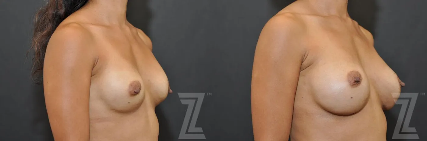 Austin Breast Augmentation Revision Before & After Gallery - Patient 132886551 - Image 4 - The Piazza Center