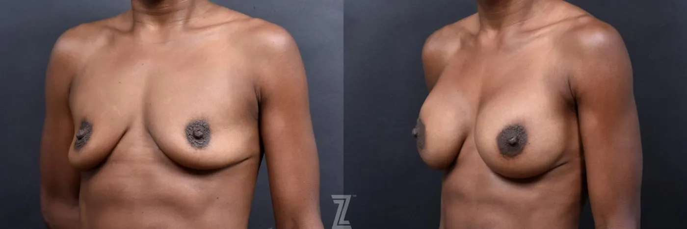 Austin oblique view of before and after view of 33 year old athletic mom of two children breast augmentation - The Piazza Center