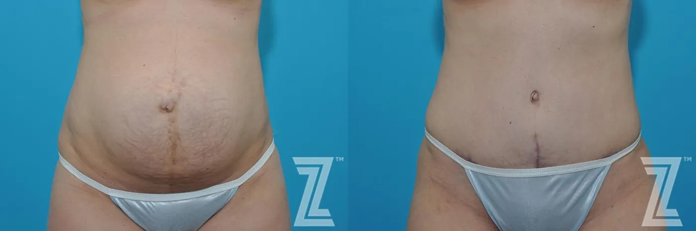 Austin Frontal abdominal view before & after 3 month post op 39 year old woman mommy make over - The Piazza Center, Austin TX - The Piazza Center