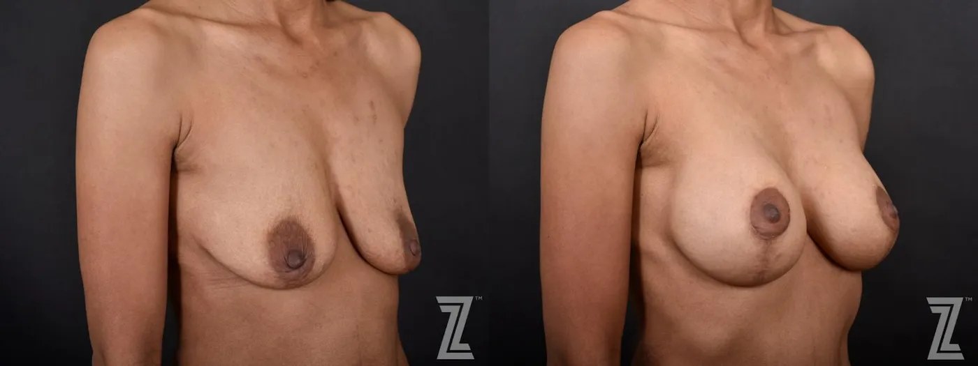 Austin 34-Year-Old Mom of Three Children Mommy Makeover Before & After by Dr. Rocco Piazza in Austin, Texas - Oblique View of Breasts - The Piazza Center