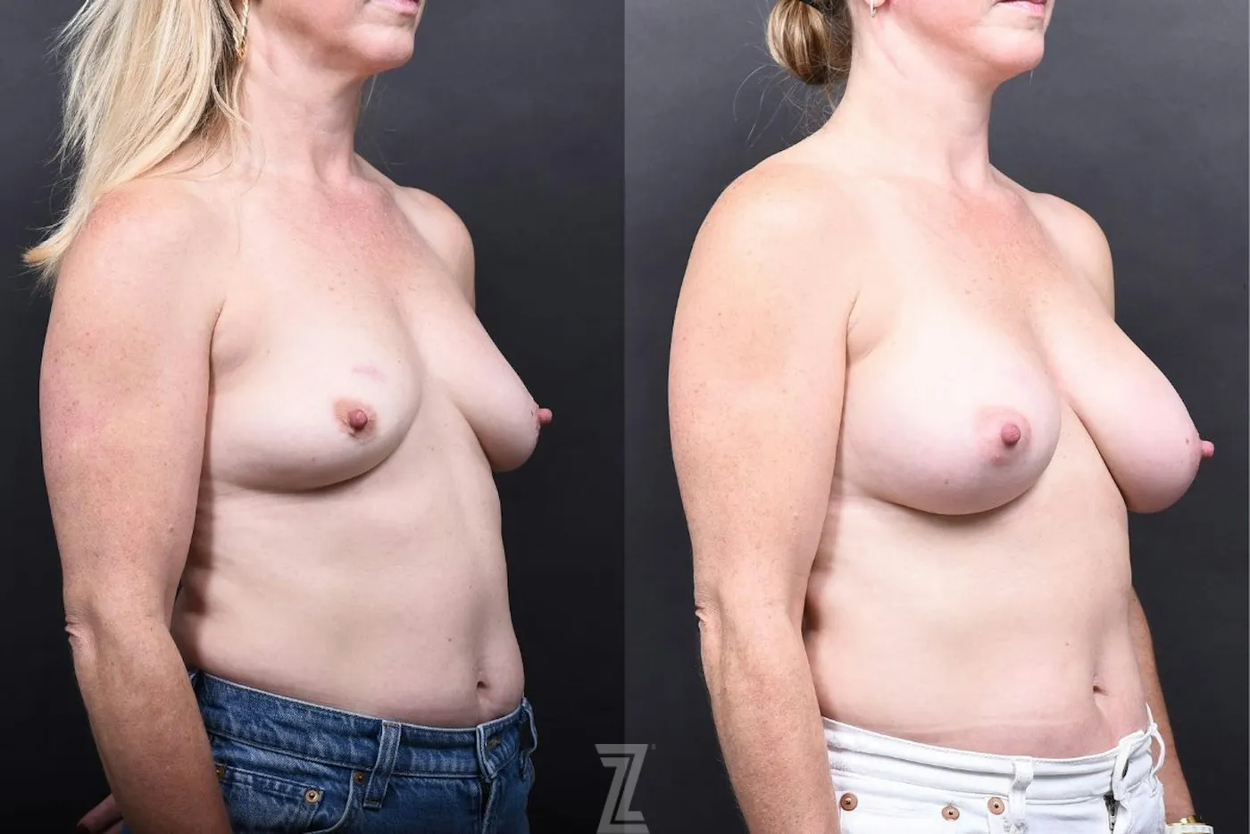 Austin Motiva Implants Before & After Gallery - Patient 441986 - Image 2 - The Piazza Center