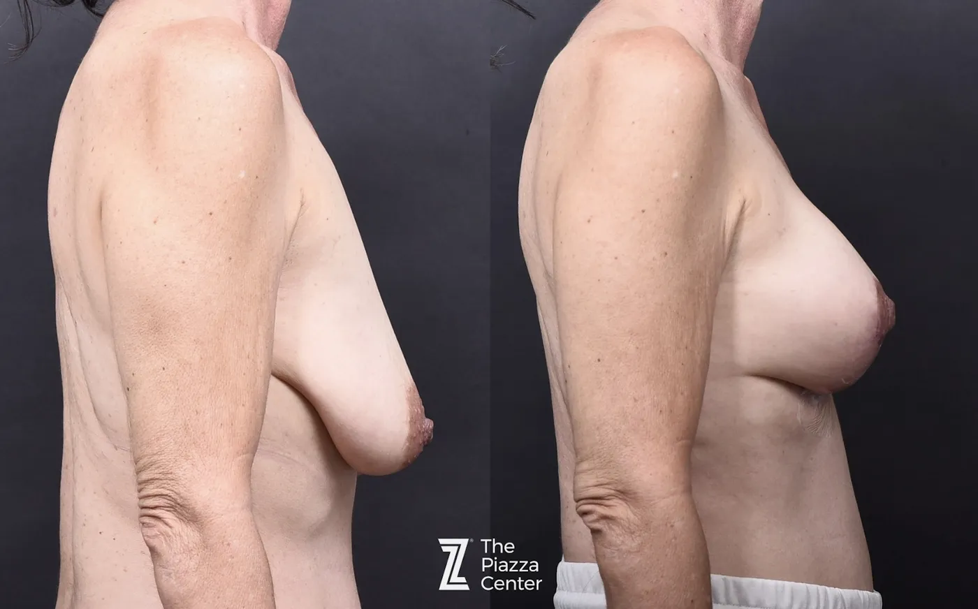 Austin Breast Augmentation With a Breast Lift - The Piazza Center