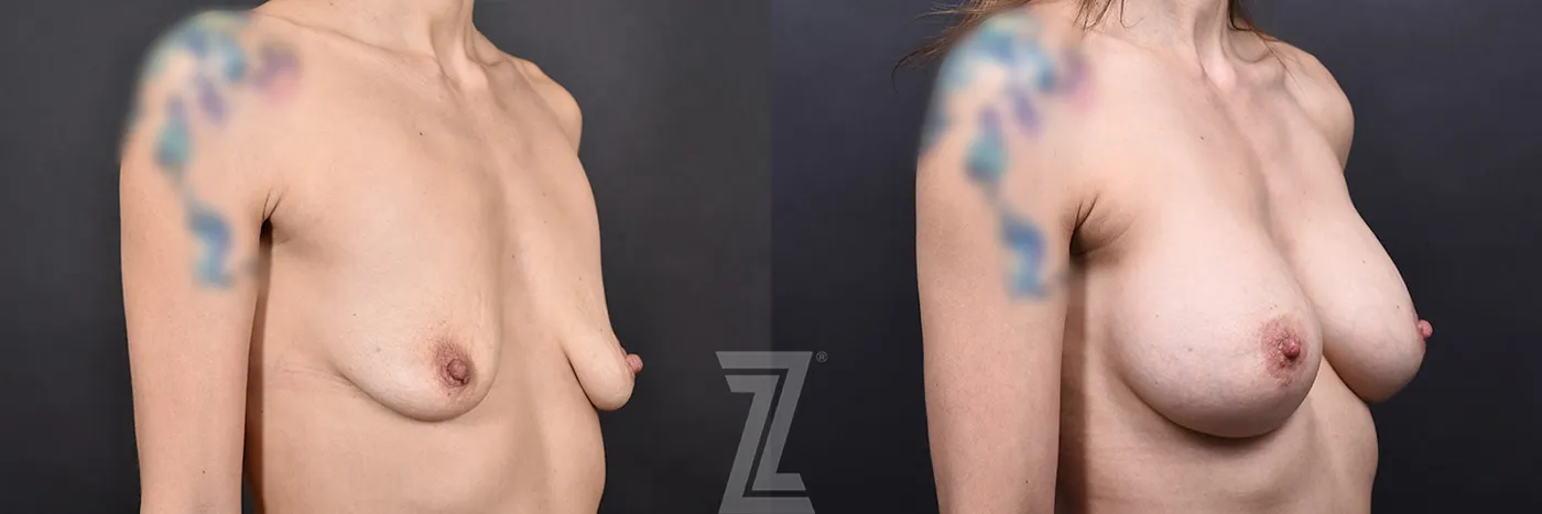 Austin Before & After Oblique View 40-year-old Mother of Two, Underwent Revision Breast Augmentation and Mastopexy to Address Sagging and Volume Loss Post-Breastfeeding in Austin, TX by Dr. Rocco Piazza - The Piazza Center