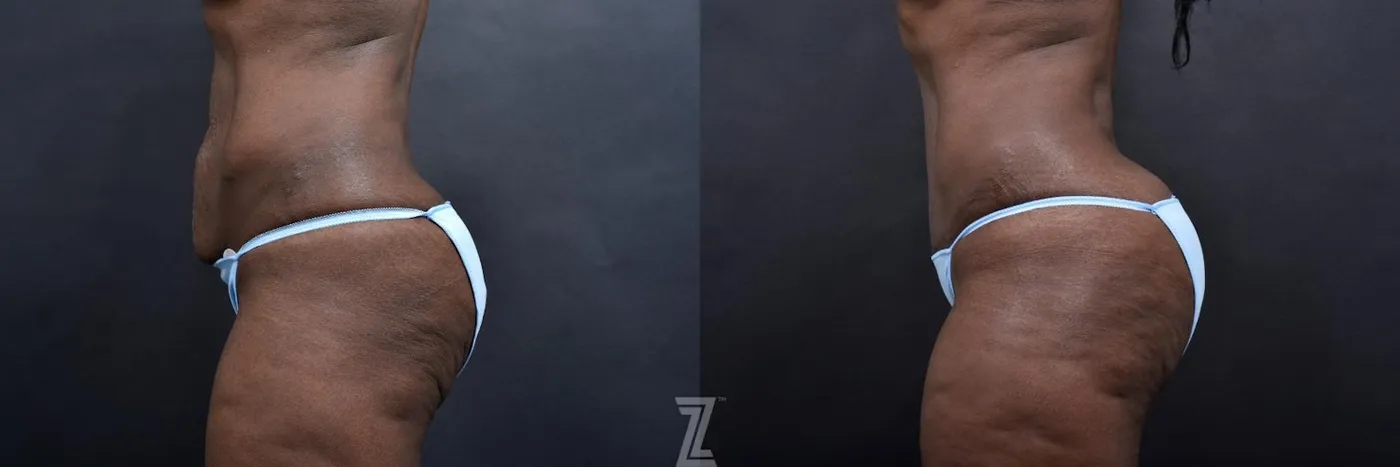 Austin Lateral Abdomen View 1 Year Post-OP Mommy Makeover in Austin, TX by Dr. Rocco Piazza - The Piazza Center