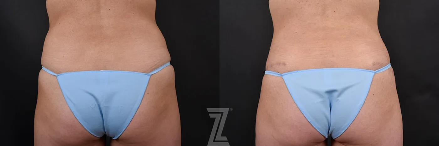 Austin Posterior View of 39-Year-Old Female Patient Mommy Makeover Before & Afters in Austin, TX - The Piazza Center - Dr. Rocco Piazza - The Piazza Center