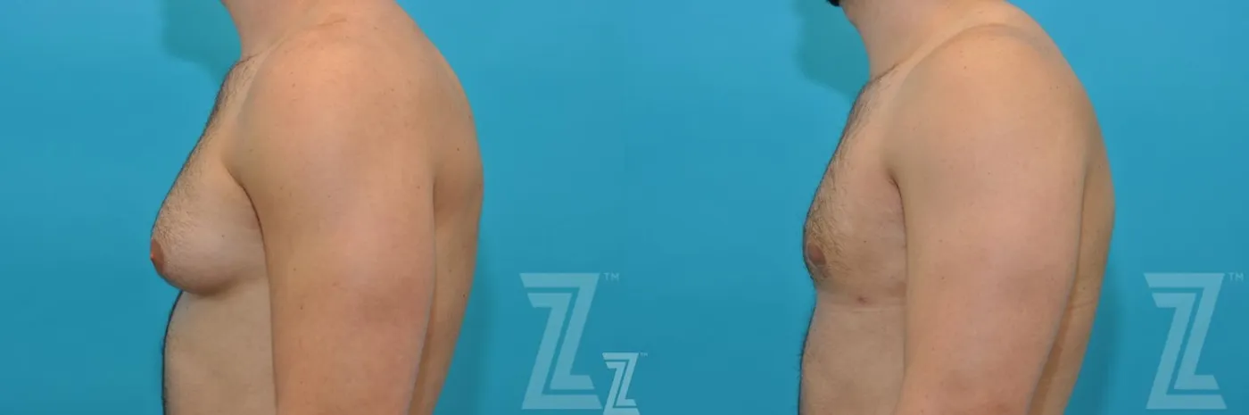 Austin Male Breast Reduction Before & After Gallery - Patient 132963603 - Image 3 - The Piazza Center